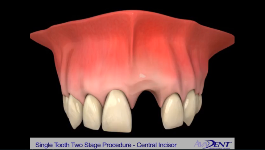 Implants for Tooth Replacement